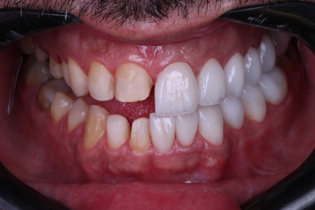 Imagem onde mostra o MockUp, onde o paciente consegue ter ideia de como vai ficar seu sorriso com as facetas.