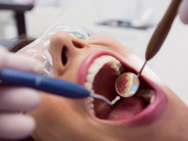 Profilaxia: O Que É e Qual a Importância para a Saúde Bucal?