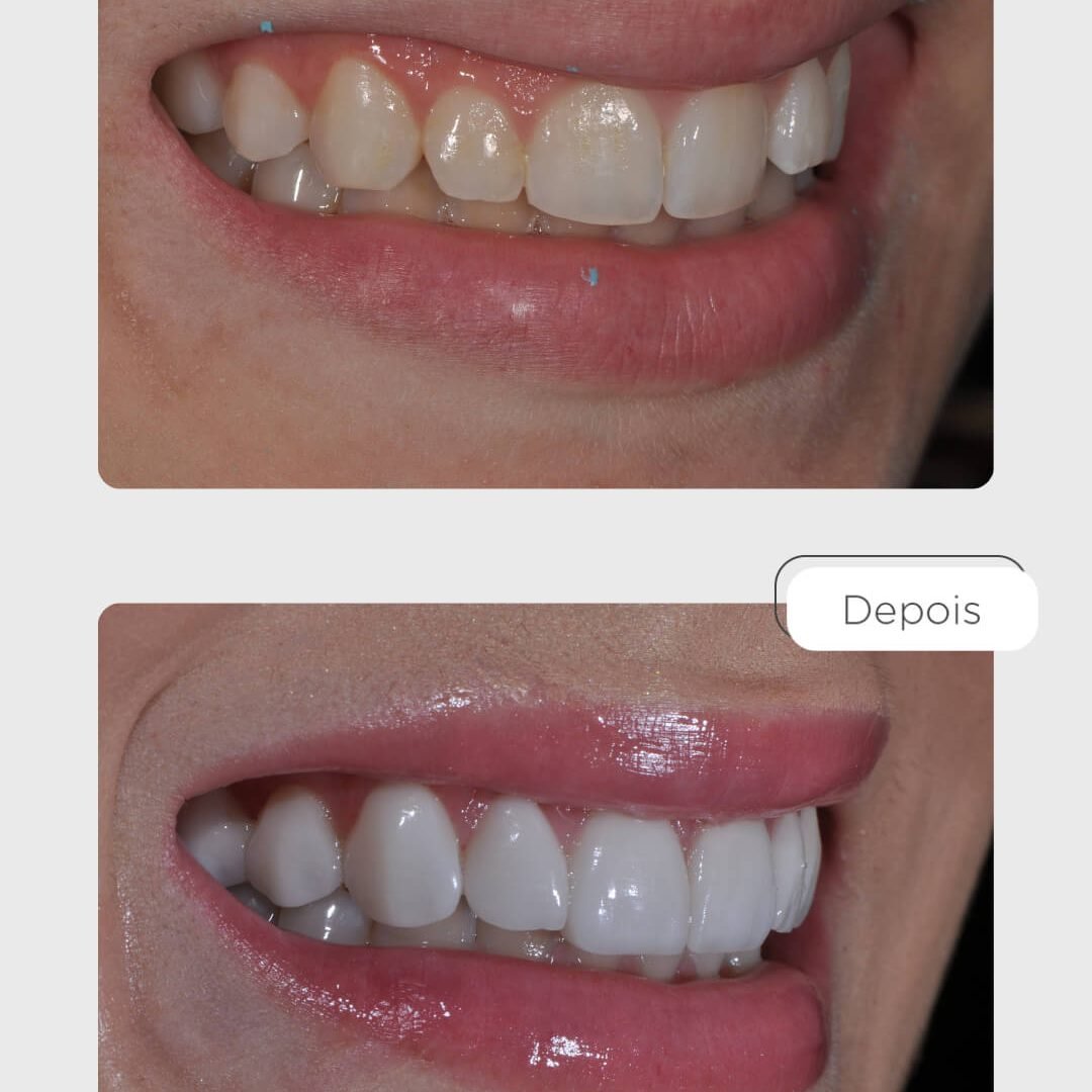 Facetas de Porcelana Clínica Castell Água Verde.jpg (4)